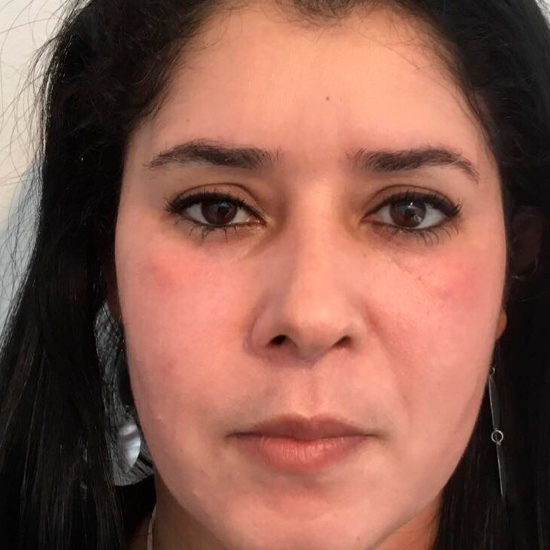 Después — Tratamiento de manchas faciales