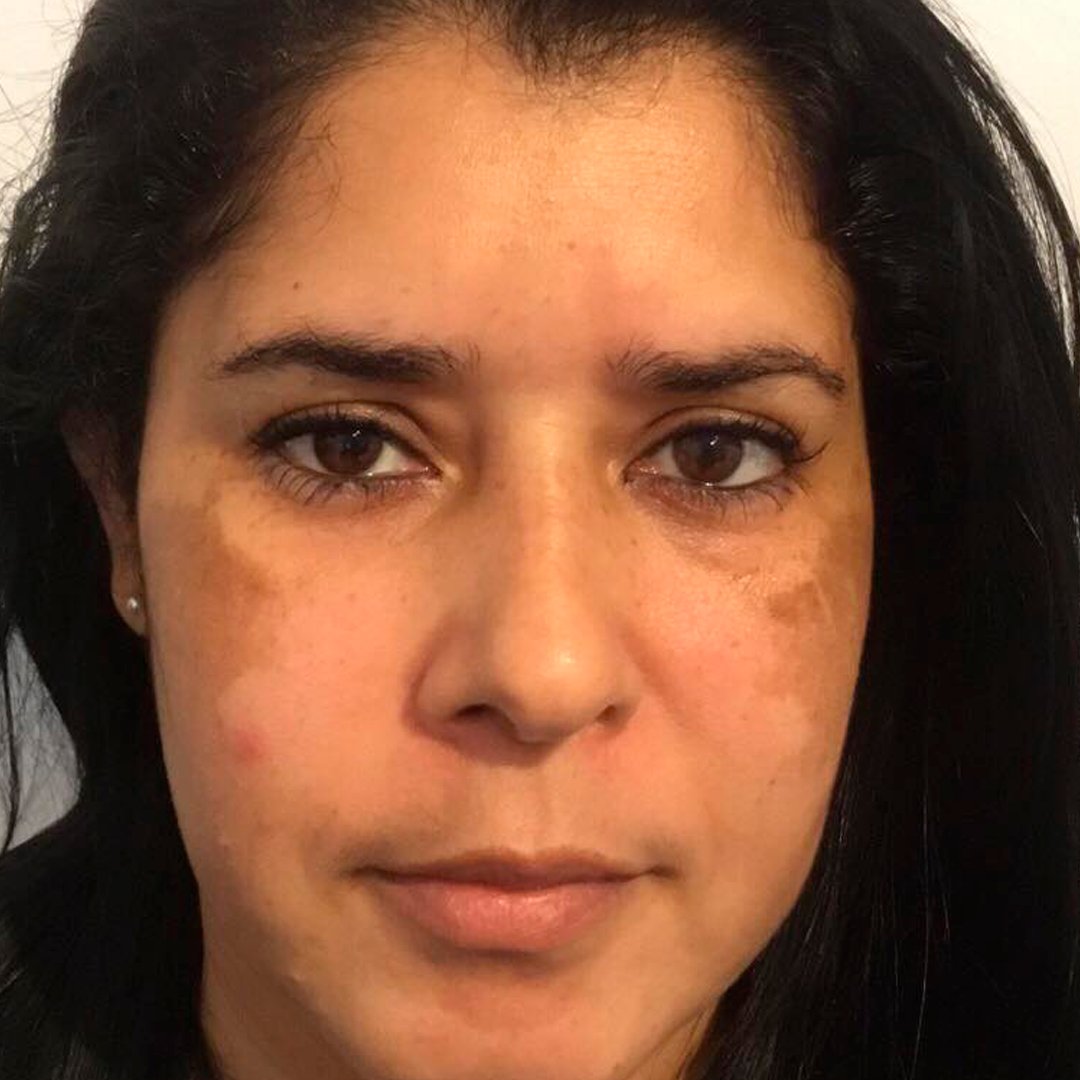 Antes — Tratamiento de manchas faciales