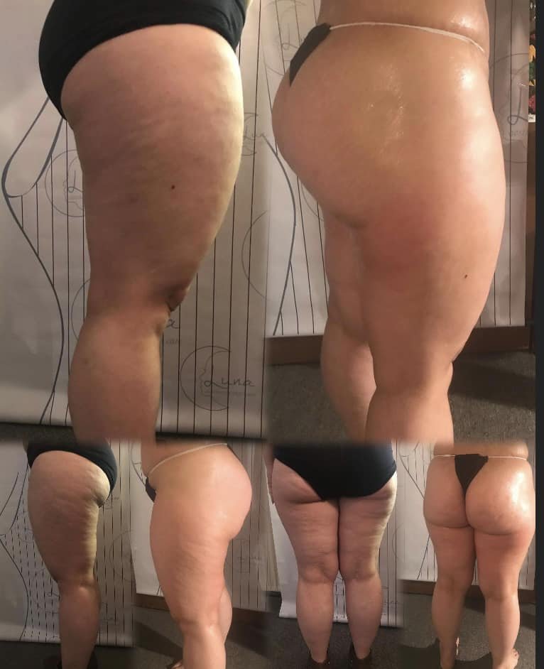 Resultado contorno corporal — Luna Aesthetics